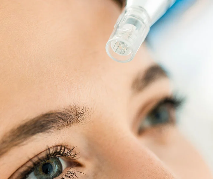 Woman receiving Microneedling procedure